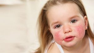 Bebeklerde en sık görülen besin alerjisi: İnek sütü protein alerjisi