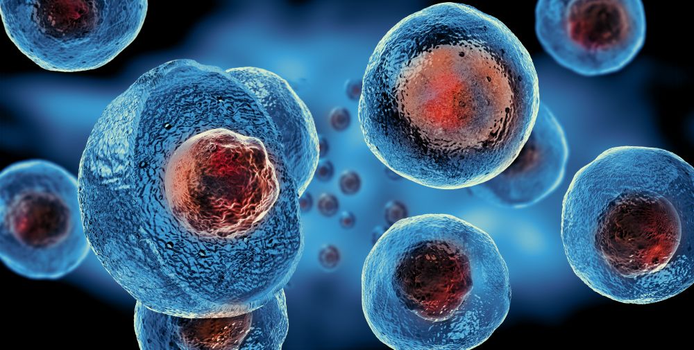 Akut miyeloid lösemi tedavi edilebilen bir hastalıktır