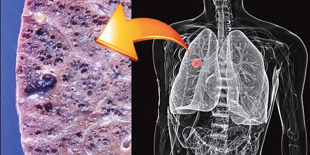 Nadir bir hastalık olan İdiyopatik Pulmoner Fibrozis’de farkındalık büyük önem taşıyor