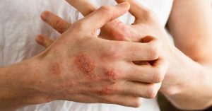 Atopik dermatit hastaları için özgürlüğe yelken açıldı