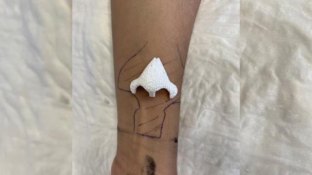 Kanserle savaşan kadın kolunda yeni bir burun büyüttü
