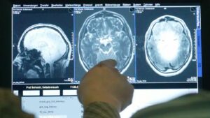 Alzheimer’ın sırrı çözüldü