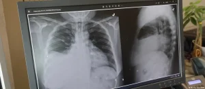 Mezotelyoma Farkındalık Günü: Mağdurlar anlatıyor