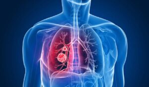 Aşıyla zatürreyi önlemek mümkün